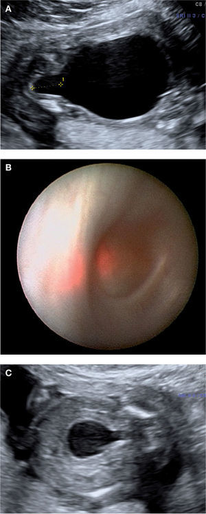 Obstrucción urinaria baja. A) Anhidramnios, vejiga extremadamente dilatada y signo de la cerradura (key sign). B) Visión endoscópica del cuello vesical y uretra dilatada desde la vejiga en el mismo caso. C) Aspecto ecográfico 2 días después de la fulguración de las valvas, con recuperación del líquido amniótico.