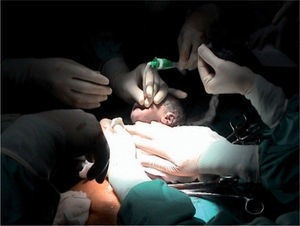 Técnica EXIT. Intubación fetal bajo anestesia total materna y fetal, manteniendo respiración fetal por vía placentaria.