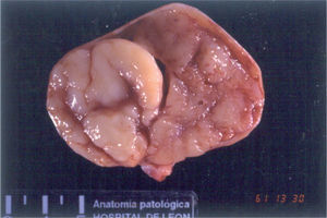Aspecto macroscópico al corte de los tumores de células de la granulosa. La coloración amarillenta-pardusca indica producción esteroidea. (Imagen del Servicio de Anatomía Patológica del Hospital de León).