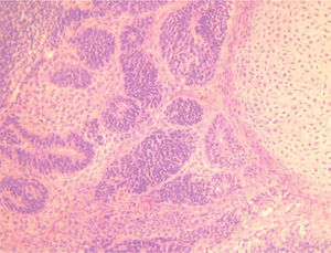 Rosetas y túbulos neuroectodérmicos en un fondo de tejido glial inmaduro. Área de cartílago inmaduro adyacente (zona derecha) (H-E x200).