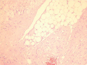 Implante en el epiplón de tejido glial maduro (HE x200).