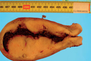 Anatomía macroscópica. Lesión tumoral sólida blanquecina, con focos pigmentados, que se extiende desde el fondo uterino hasta prácticamente alcanzar el orificio cervical. La lesión infiltra la pared uterina dejando un margen libre de 0,3cm en las zonas de mayor infiltración.