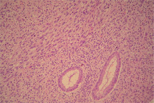 Afectación de endocérvix por células tumorales melánicas.