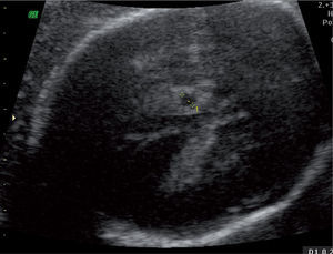 Corte transversal de cabeza fetal con imagen anecoica de 29mm de aspecto quístico, en el interior del plexo coroideo.