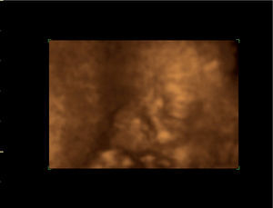 Corte coronal anterior del perfil fetal en ecografía tridimensional. Se aprecian las anomalías del fenotipo.