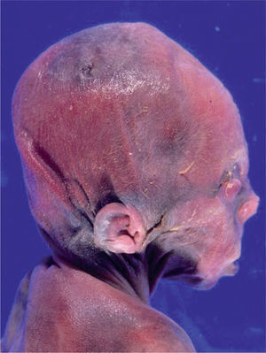 Aspecto macroscópico del perfil fetal.