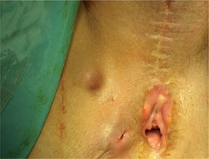 Nódulos tumorales en el lado derecho de la zona vulvar. Se aprecian las cicatrices de la vulvectomía previa.