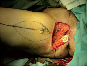 Preparación para la disección del músculo gracilis de la pierna derecha.