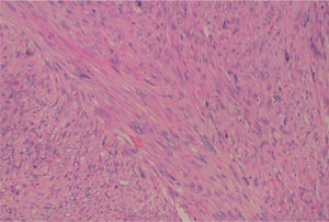 Lesión de aspecto fasciculado, hipercelular (HE, ×100).