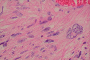 Histología que muestra la atipia celular (HE, ×400).