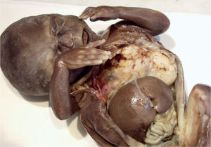 Malformación adenomatoide quística pulmonar. Imagen de la necropsia.