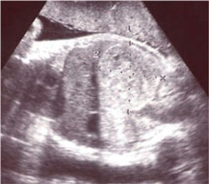 Ecografía abdominal: masa hiperecogénica, bien definida, de 60×56×76mm, localizada en la fosa renal derecha fetal.