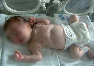 Exploración física del recién nacido en que se observa una marcada distensión abdominal.