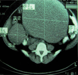 Imagen de tomografía computarizada. Lesión ocupante de espacio en región pélvica (flecha roja).