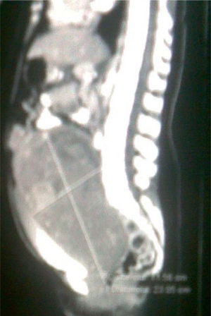 Imagen de tomografía computarizada. Lesión ocupante de espacio en la región pélvica (flecha).