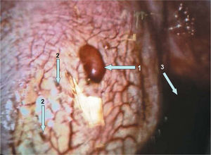 Foco de tejido endometrial en pleura diafragmática. Visualización mediante videotoracoscopia. 1: foco de endometriosis pleural con hematoma central; 2: focos de endometriosis pleural de color pardusco; 3: restos de hemotórax en la cavidad pleural.