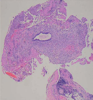 Aspecto histológico de tejido endometrial en pleura diafragmática. 1: glándula endometrial de aspecto ondulante, en fase secretora del ciclo menstrual; 2: estroma endometrial; 3: aspecto vascular de estroma endometrial en fase secretora; 4: tejido de la pleura diafragmática; 5: adipocitos de pleura parietal.