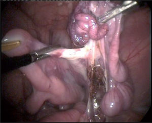 Resección de cuerno uterino derecho.