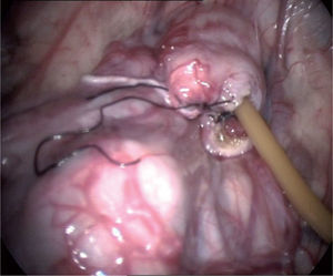 Cistostomía con sonda de Foley.