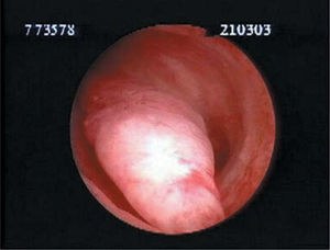 Pólipo endometrial de aspecto benigno.