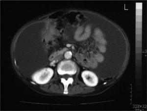 Tomografía computarizada abdominopélvica. Gran ascitis y carcinomatosis.