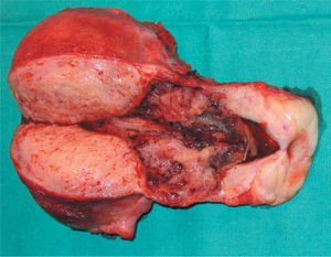 Corte longitudinal sobre pieza de histerectomía. Trofoblasto en el tercio superior cervical, zona de implantación del embarazo ectópico.