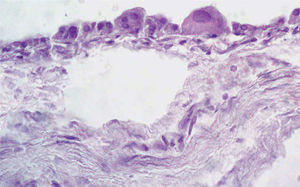 Células foliculares luteinizadas con citoplasma eosinófilo de la pared del quiste. Tinción con hematoxilina- eosina.