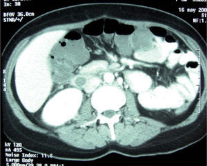 Tomografía computarizada con contraste donde se pone de manifiesto un trombo flotante en la vena cava inferior a nivel de la bifurcación de la arteria renal derecha.