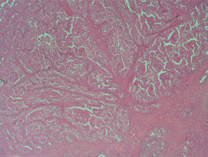 Imagen histológica de una zona de adenocarcinoma endometrioide, bien diferenciado (grado 1). Se aprecian las áreas glandulares distorsionadas y con fusión de paredes, indicativas de malignidad (HE ×10).