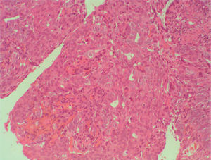 Detalle del adenocarcinoma endometrioide en el que se pueden apreciar la atipia nuclear leve (grado nuclear 1) y el patrón de fusión glandular (HE ×.40).