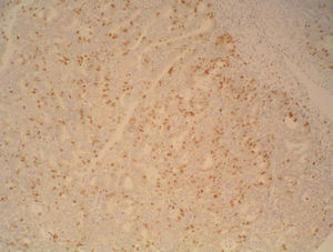 Receptores de estrógenos. Expresión inmunohistoquímica nuclear para receptores de estrógenos en aproximadamente el 50% de las células tumorales, con intensidad moderada a intensa (IHQ ×20).