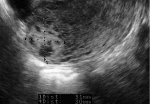 Imagen obtenida por ecografía transvaginal el día 8 en la que se evidencia una imagen heterogénea de 31 × 30mm, correspondiente a la gestación ectópica en el cuerno uterino derecho en un corte transversal del útero.