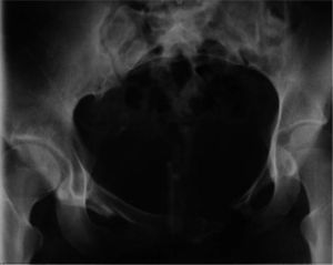 Radiografía abdomino-pélvica que muestra lesión pélvica residual tras un accidente de tráfico.