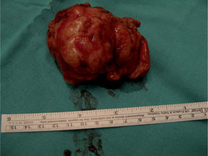 Pieza quirúrgica. Formación irregularmente nodular de 8cm de diámetro máximo y superficie externa lobulada.