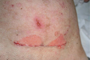 Cicatriz de laparotomía con sutura intradérmica y lesiones erosivas pericicatriciales en el segundo día poscesárea.