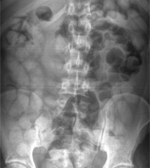 Radiografía simple de abdomen de body packer.