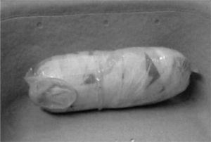 Envoltorio extraído de vagina con varios paquetes de droga en su interior.