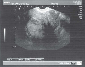 Imagen ecográfica compatible con mioma uterino que correspondió a un tumor esclerosante estromal ovárico.