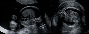 Hidropesía fetal con polihidramnios severo asociado a quilotórax.