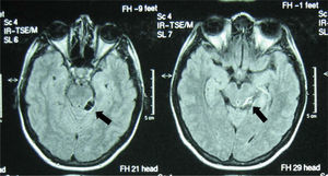 Imagen de resonancia magnetica cerebral. Secuencia Flair que muestra una imagen de características quisticas con pared engrosada de unos 1,5 cm y localizada en la porción izquierda de la lamina cuadrigemina compatible con neurocisticercosis.