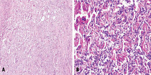 A) Proliferación de células fusiformes en citoplasma discretamente eosinófilo, proliferación vascular. B) Proliferación vascular que adoptando patrón hemangiopericitomatoide.