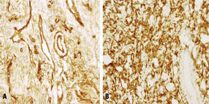 A) Positividad evidente de las células fusiformes a la tinción para CD34. Se observa también positividad vascular. B) Positividad intensa para la tinción con bcl-2 en las células tumorales.