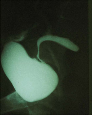 Cistografía: se observa el paso de contraste de la vejiga al útero por el trayecto fistuloso. Además, se observa un reflujo de orina al uréter derecho, posiblemente debido a un proceso secundario a una infección urinaria.
