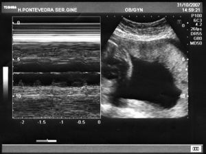 Ecografía en modo-M con disociación aurículo-ventricular.