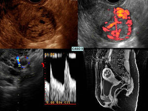Caso 8: ecografía 2D vaginal Doppler Color y Energía e imagen RNM del caso.