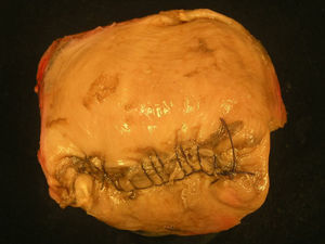 Superficie exterior uterina con sutura fúndica a nivel de la rotura.