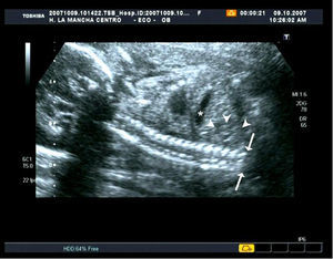 Ecografía 2D. Corte longitudinal del feto que muestra la agenesia lumbosacra. Las puntas de flecha señalan la silueta del riñón izquierdo; el asterisco está situado en la cámara gástrica y las flechas enmarcan el final de la columna a nivel de la 3.a-4.a vértebra lumbar.