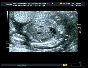 Ecografía 2D. Corte sagital del feto a nivel pélvico que muestra la agenesia sacra. El asterisco está situado en la vejiga, la flecha señala el fémur derecho y las puntas de flecha indican la zona donde debería estar situado el sacro.