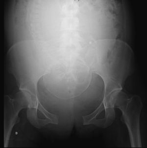 Radiografía simple de pelvis donde se visualiza un ensanchamiento evidente de la sínfisis púbica.