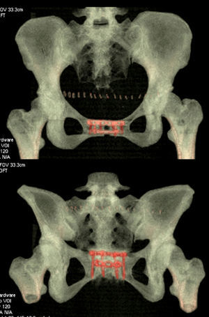Comprobación de emplazamiento de placas osteosíntesis tras la cirugía.